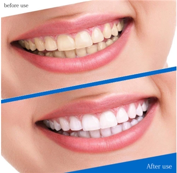 Whitening Strips for Teeth